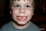 First Tooth